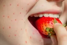 علایم حساسیت به توت فرنگی